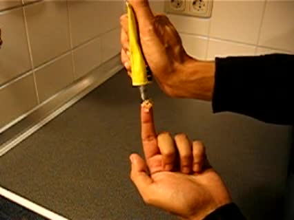 Splitter im Finger entfernen - mit Klebstoff